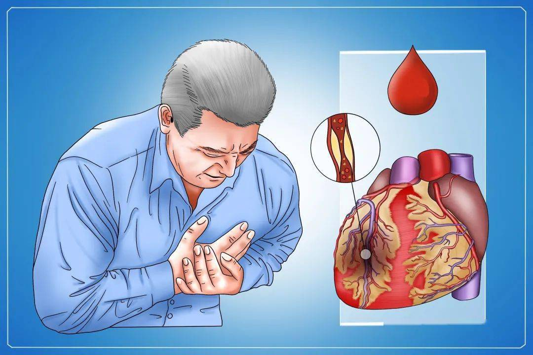【養生保健】警惕11個容易忽略的心梗預兆訊號